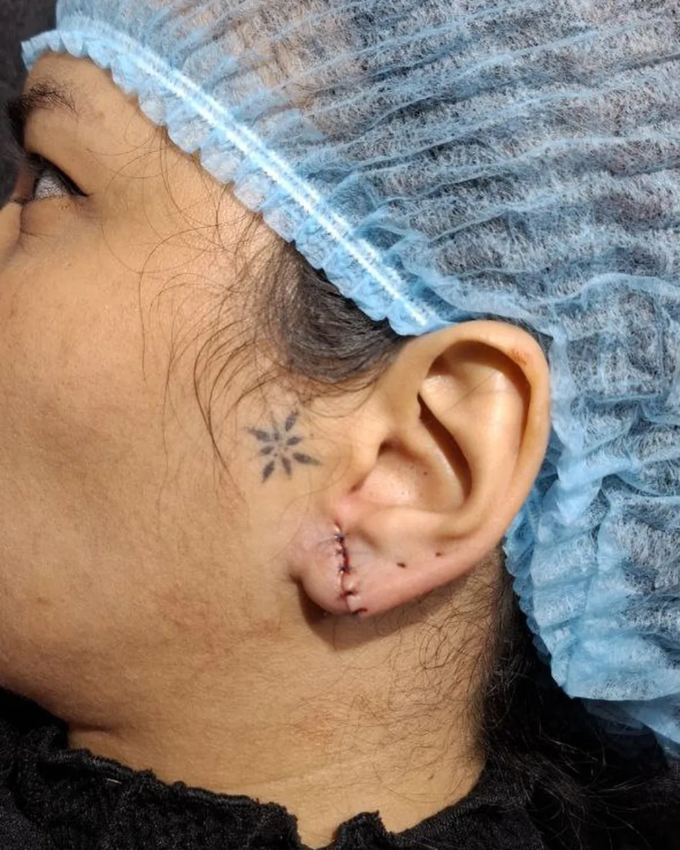 Lóbulo de la oreja con puntos de sutura después de una lobuloplastia, hecha en el estudio